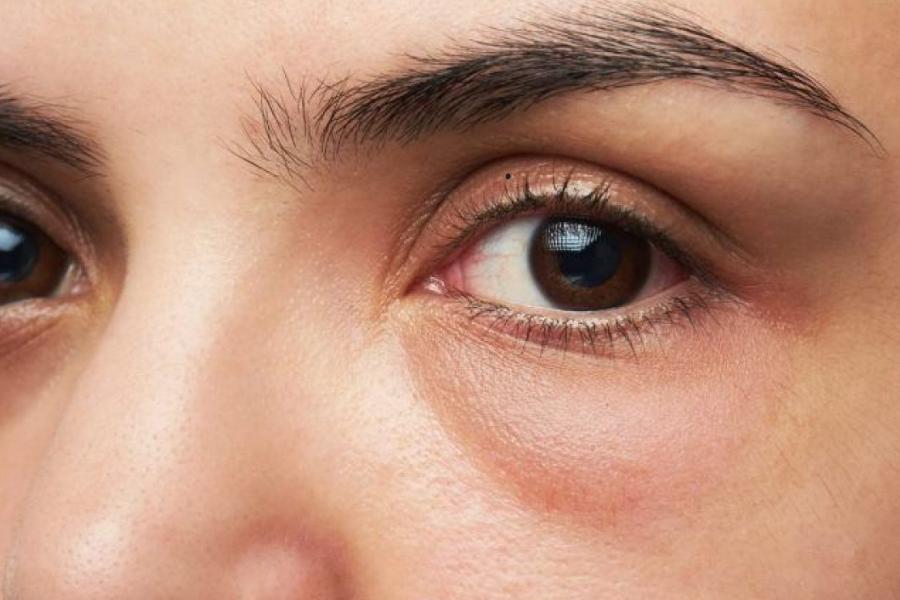 Nốt ruồi trên mí mắt có ý nghĩa gì và có tốt không?